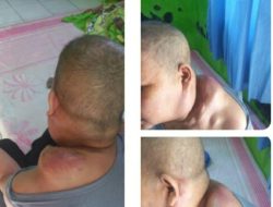 Kisah Pilu Mak Senah, Warga Salimah Sukamanah RT/RW/0015/005 Menderita Tumor Getah di Bagian Pundak